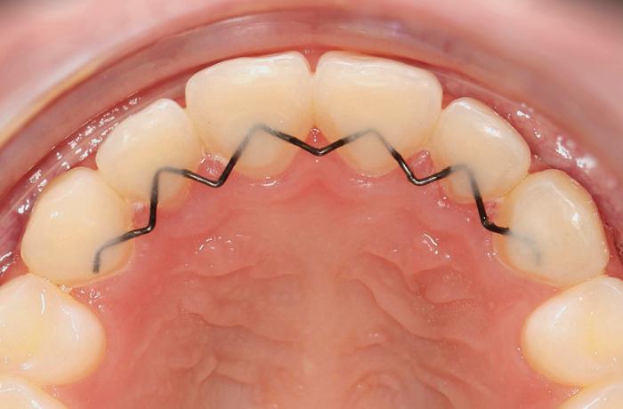 Metal Braces vs Ceramic Braces: Which One’s For You?